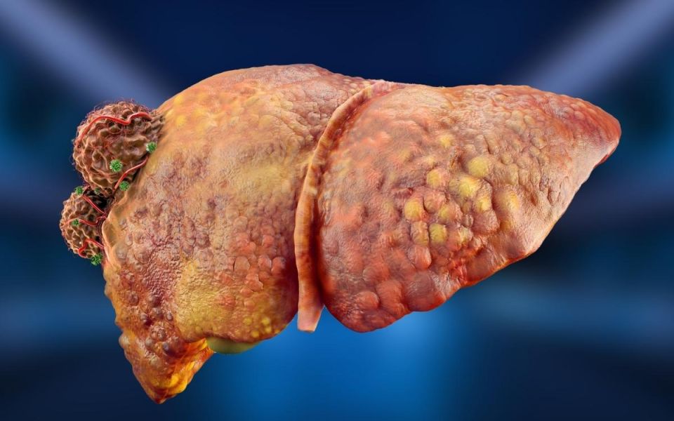 85–90% of Primary Liver Cancers Are Hepatocellular Carcinoma, Why Aren’t We Catching It Sooner?